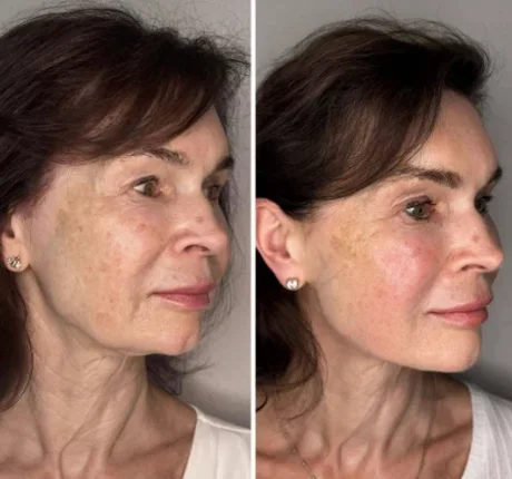 Real before and after of a skin booster course at Skin Booster Lab, Dubai
